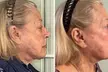 One or Three Sessions of Opus Plasma Skin- Resurfacing Session for the Face and Neck (Up to 50% Off) - Second Medium