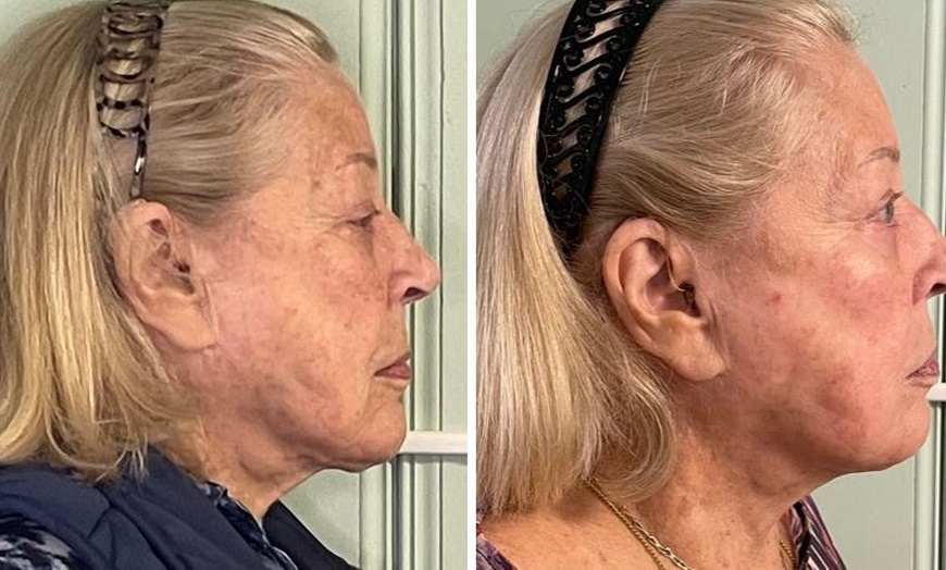 Image 2: Opus Plasma Skin- Resurfacing Session for the Face & Neck