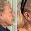 Image 2: Opus Plasma Skin- Resurfacing Session for the Face & Neck