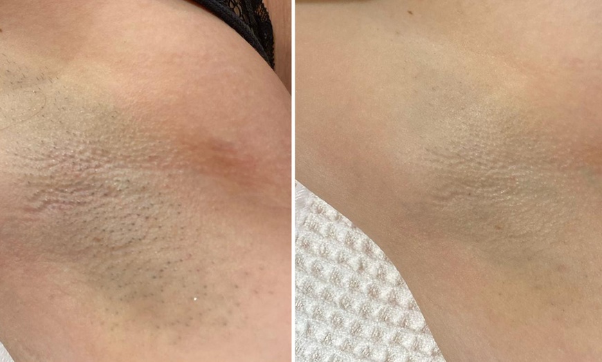 Image 5: Haarentfernung mit Dioden-Laser an 1 Zone nach Wahl für 1 Person