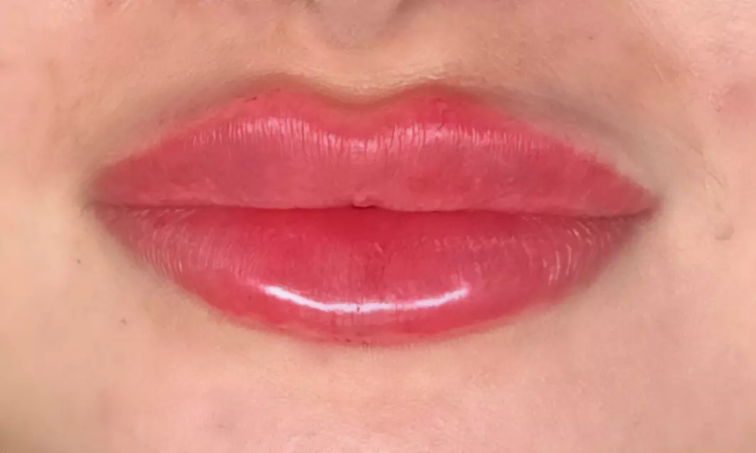 Enhance Your Natural Beauty with Dermal Filler Treatments