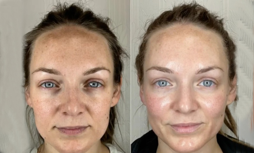 Image 2: Unleash Your Glow! Up to 72% Off Advanced Skincare Treatments!