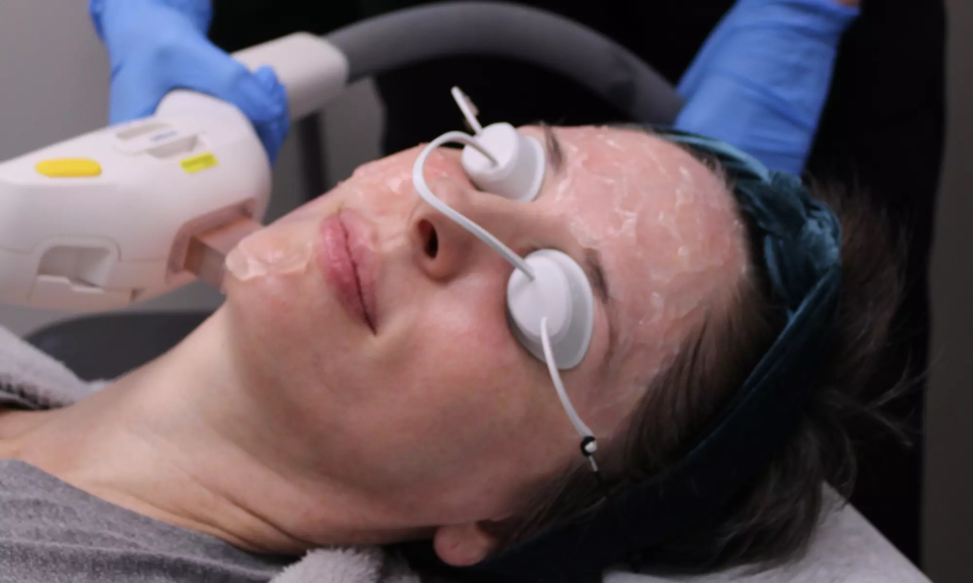 One IPL Photofacial Treatment at Total Med Solutions