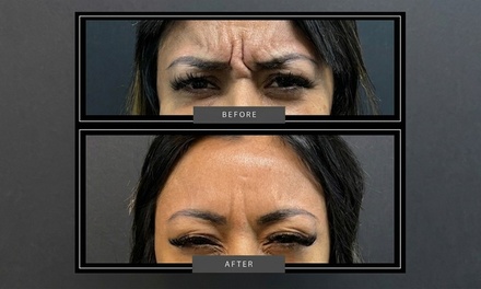 20 Units of Botox - TITE Medical Aesthetics