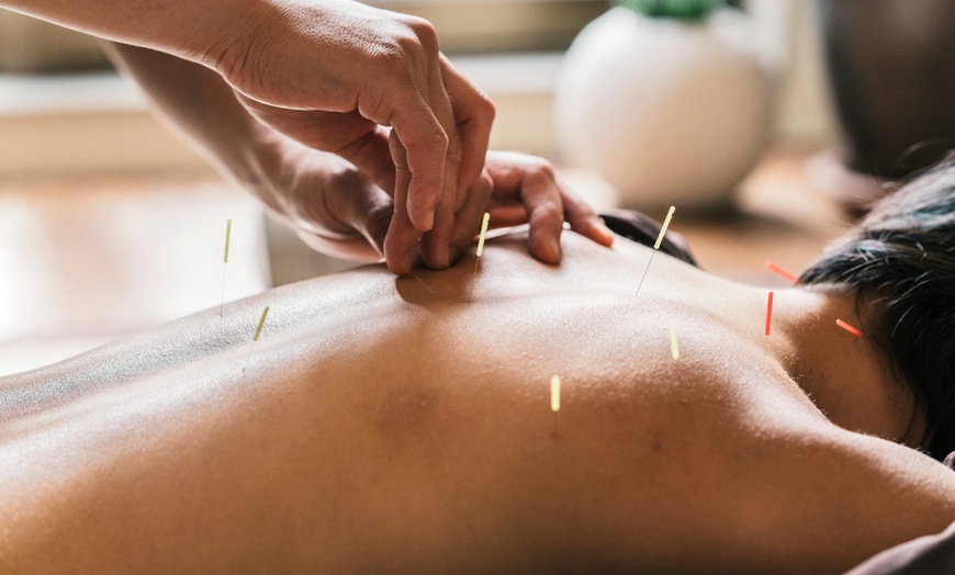 Image 1: 90-Minute Whole Body Acupuncture Session w/Initial Consultation & More