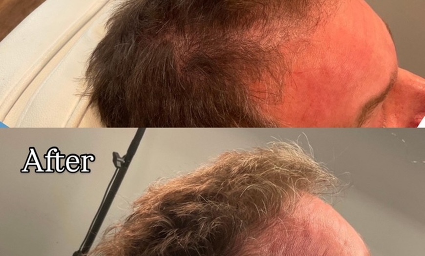 Image 7: Revitalize Thinning Hair w/ Needle-Free Alma TED Sessions