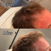 Image 7: Revitalize Thinning Hair w/ Needle-Free Alma TED Sessions