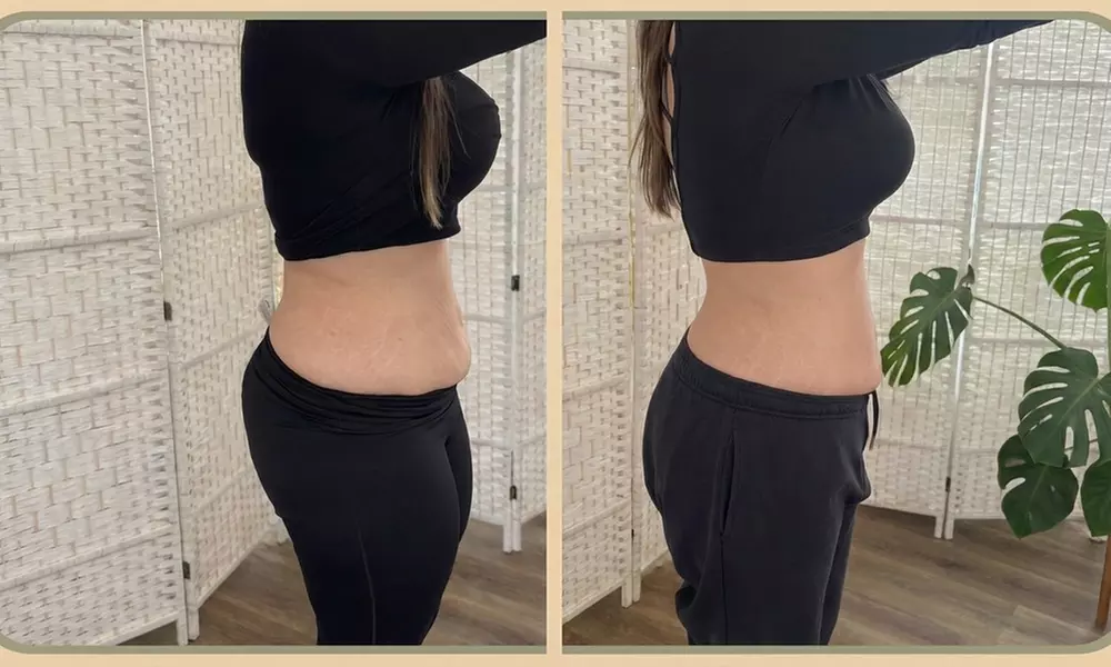 Sculpt Your Body with Two or Four Applicators: Cryolipolysis