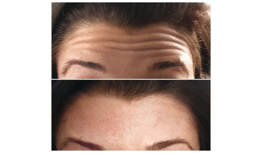 Image 6: Revitalize with 20 or 40 Units of Botox Or One Flip Lip