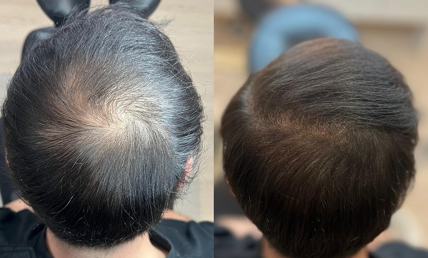 Image 2: Haarpigmentierung, Narbenkorrektur oder Kurzhaarschnitt für 1 Person