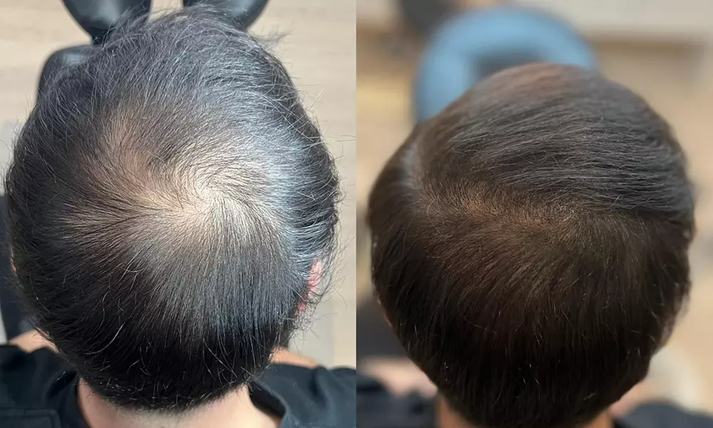 Haarpigmentierung, Narbenkorrektur oder Kurzhaarschnitt für 1 Person