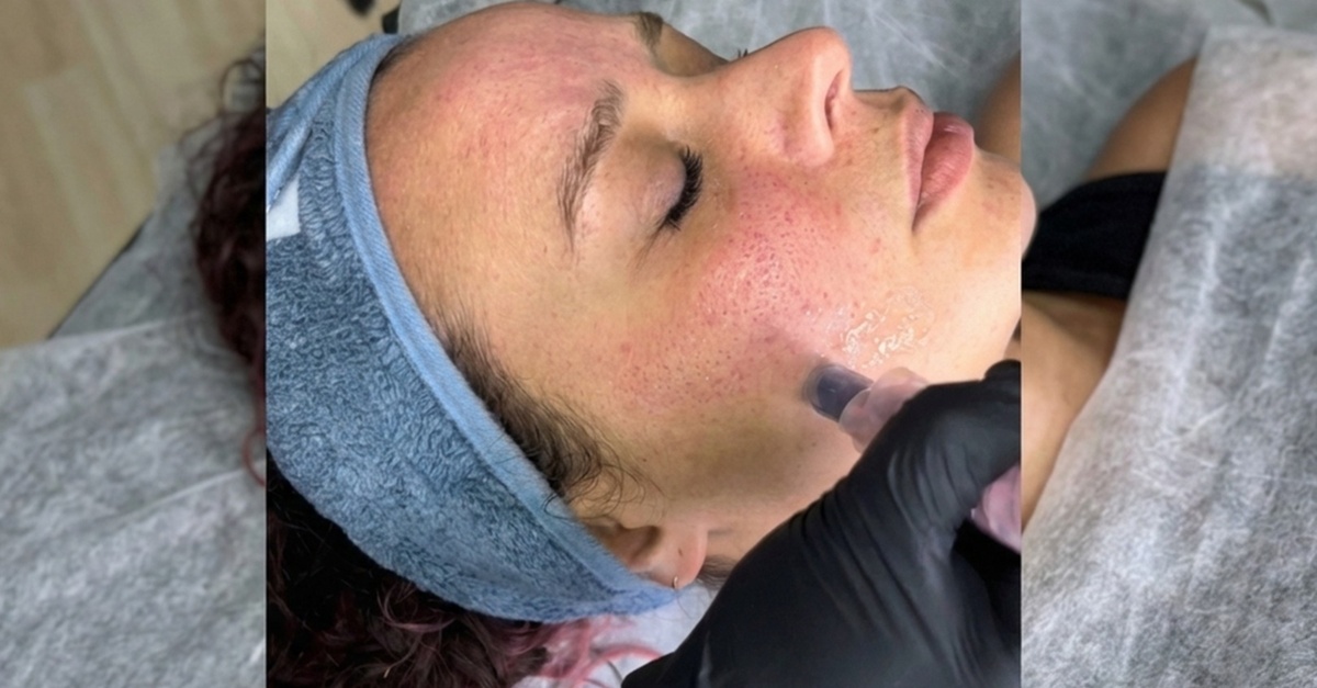 Sesiones de microneedling facial en Bilbao