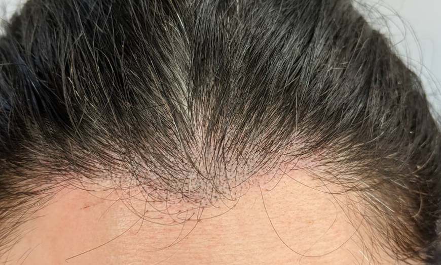 Image 3: Comprehensive Scalp Micro Needling Session -One, Three or Five 60 Min 