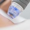 Image 3: Gesichtsbehandlung mit Radiofrequenz-Needling & optionaler Hautanalyse