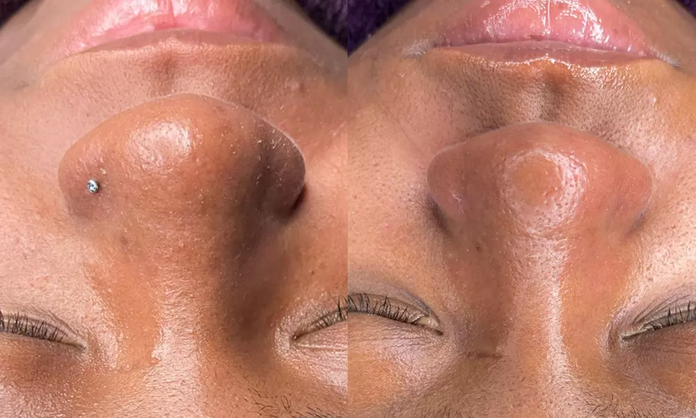 One, Three, or Five Sessions of Advanced HydraFacial or DermaPlaning