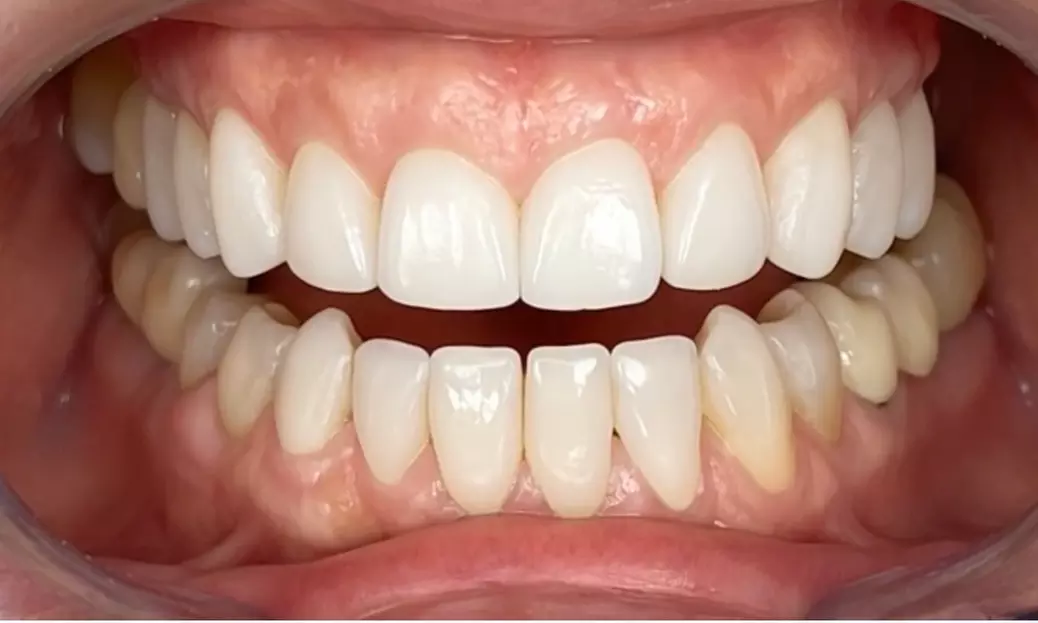 Empastes o coronas de zirconio con diagnóstico incluido en centro médico La Masò para 1 persona - Primary Image