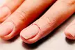 Medical Pedicure, Callus Reduction / Nail Fungus Consult @ Elite Laser Therapy of Northern Nevada—Up to 55% Off - Second Medium