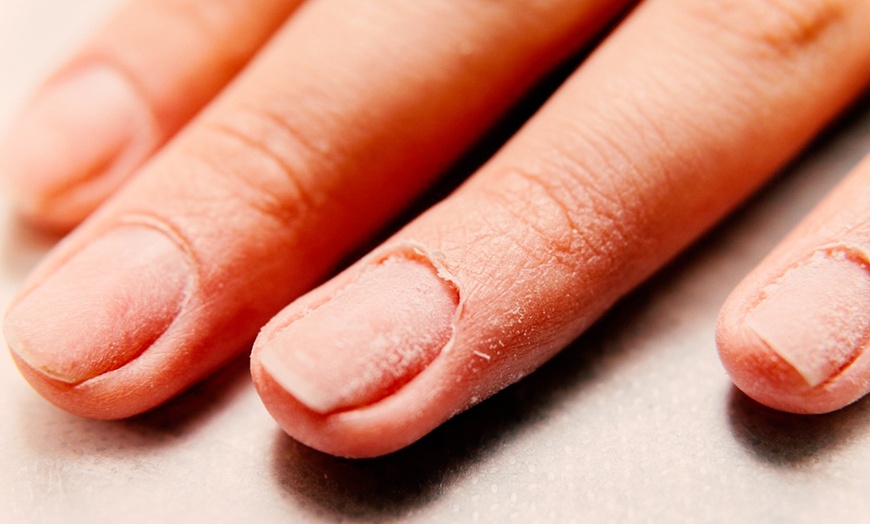 Image 2: Medical Pedicure, Callus Reduction or Nail Fungus Consultation
