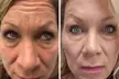 Lip Flip or 20–40 Xeomin Units for Smoother Skin & Fuller Lips at Slim Fit Beauty Up To  59% Off - Second Medium