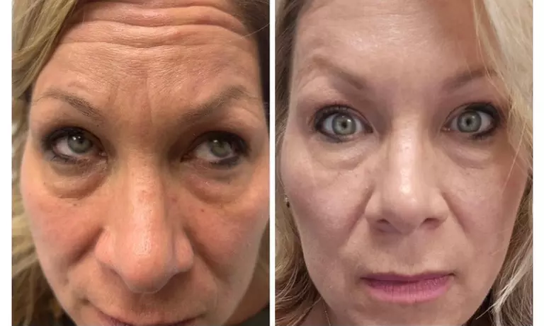 Lip Flip or 20–40 Units of Xeomin for a Smooth, Youthful Look