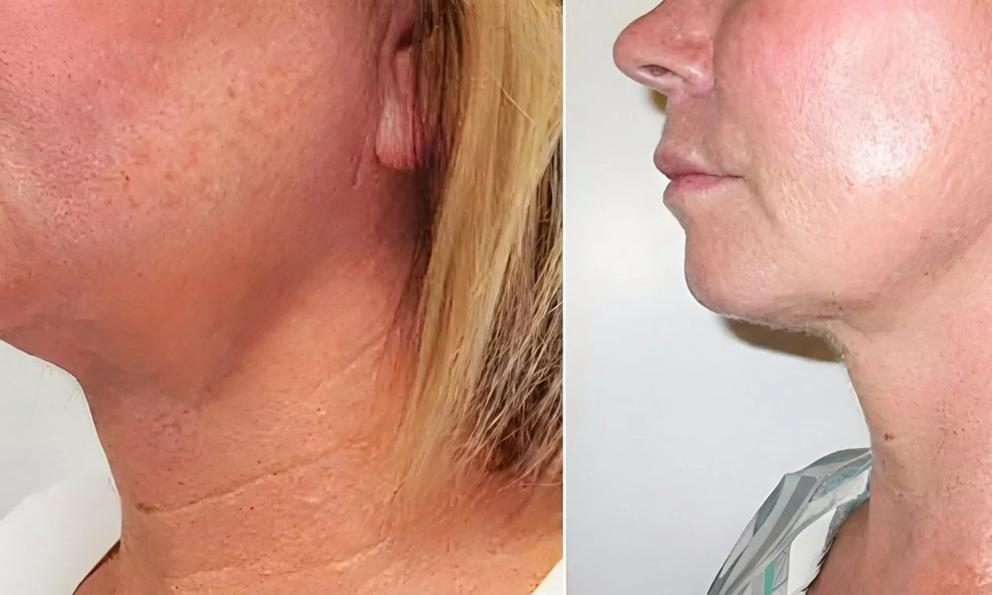 VelaShape Sessions for Targeted Body Contouring & Cellulite Reduction