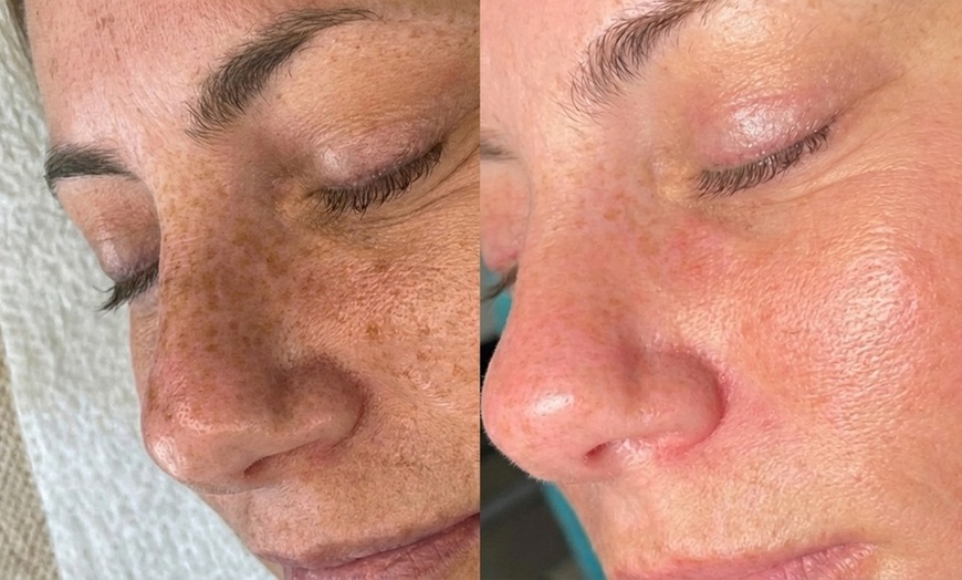 Image 2: Rejuvenate with One IPL Photo Facial for Face, Neck and Optional Chest