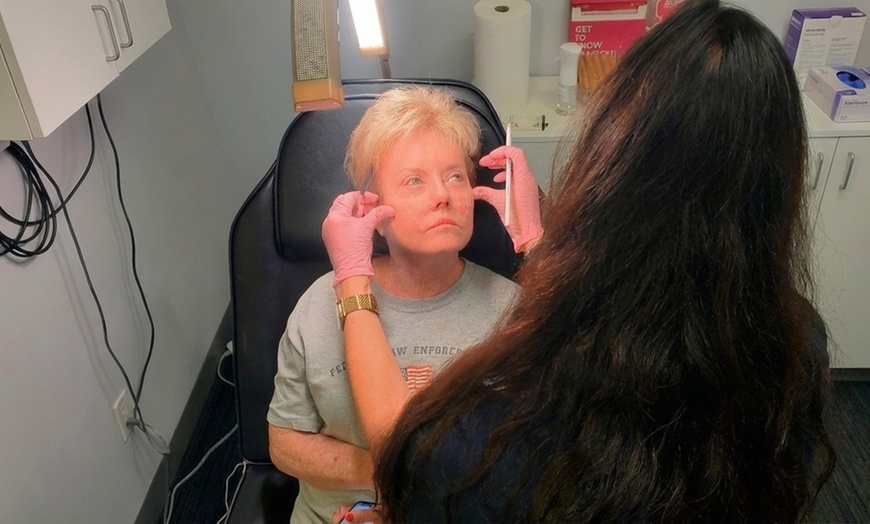 Image 2: Lip Filler and Enhancement Options Using Evolysse