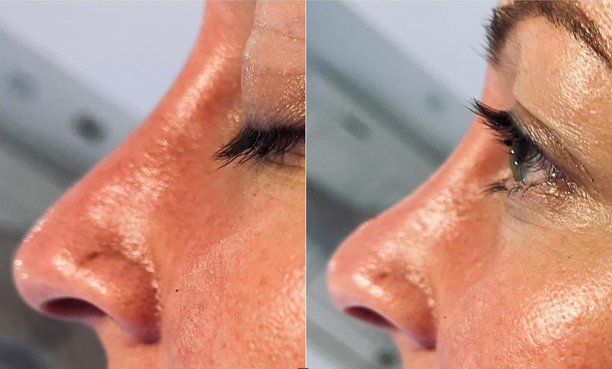 Image 3: Up to 65% Off on Injection - Dermal Filler at Dolls Aesthetics Academy