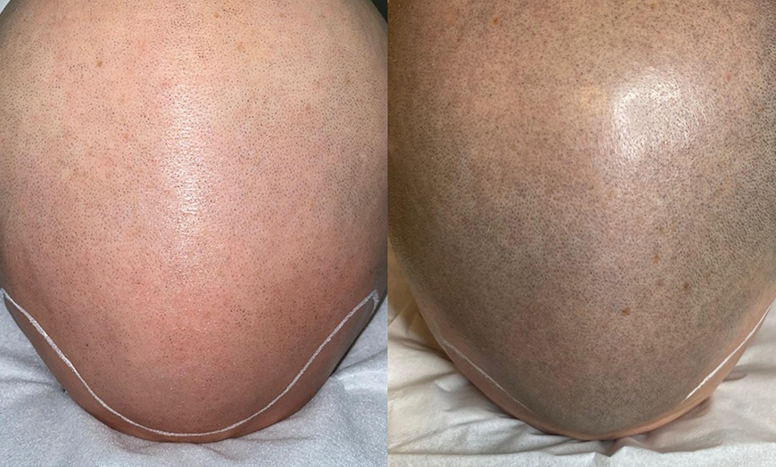 Image 3: Haarpigmentierung, Narbenkorrektur oder Kurzhaarschnitt für 1 Person