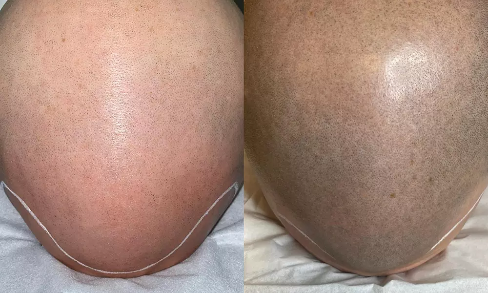 Haarpigmentierung, Narbenkorrektur oder Kurzhaarschnitt für 1 Person