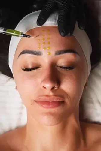 20, 40, or 60 Units of Botox for Youthful Skin