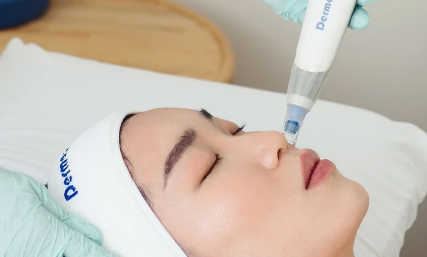 Image 3: Anti-Wrinkle Injections on One Major Area