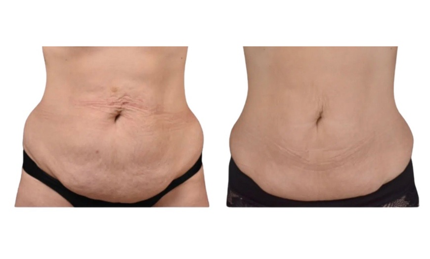 Image 2: Cryo Liposculpt Intro Sessions for Chin, Back, Arms or Thighs