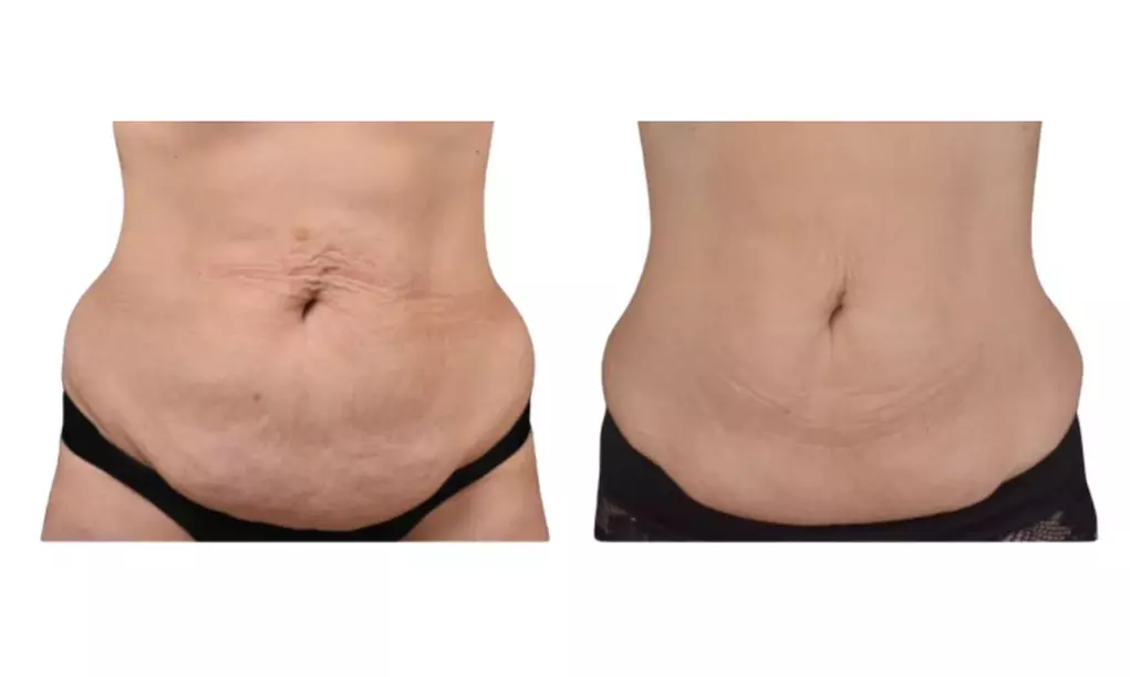 Cryo Liposculpt Intro Sessions for Chin, Back, Arms or Thighs at ELin Medical Spa (Up to 73% Off) - Second Medium