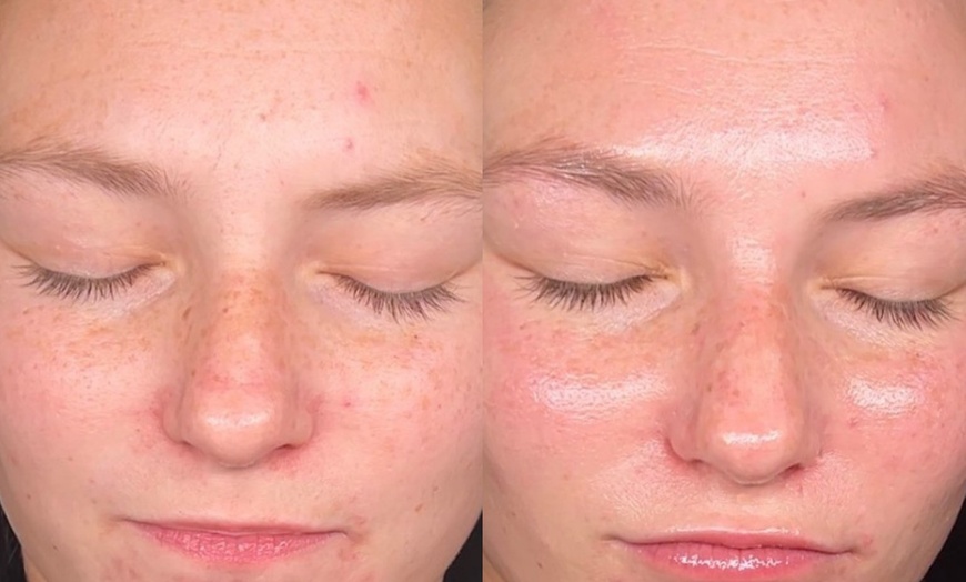 Image 3: Up to 60% Off Facials with Dermaplaning at Vibrance Med Spa