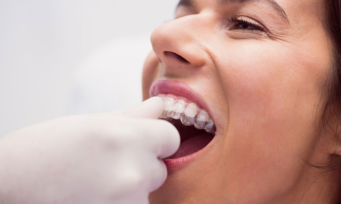 Protege tu sonrisa con una férula de descarga semirrígida