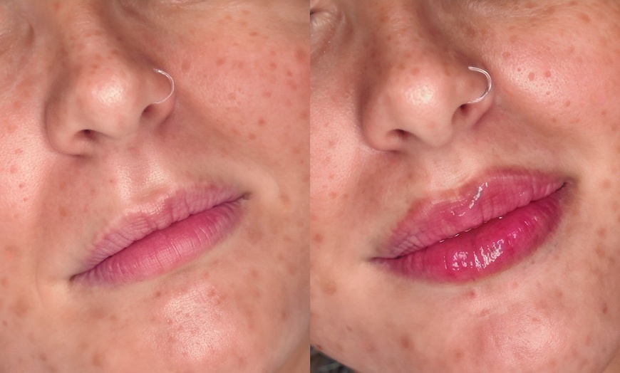Image 1: Enhance your Beauty with Dermal Filler with Consultation