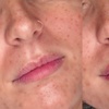 Image 1: Enhance your Beauty with Dermal Filler with Consultation