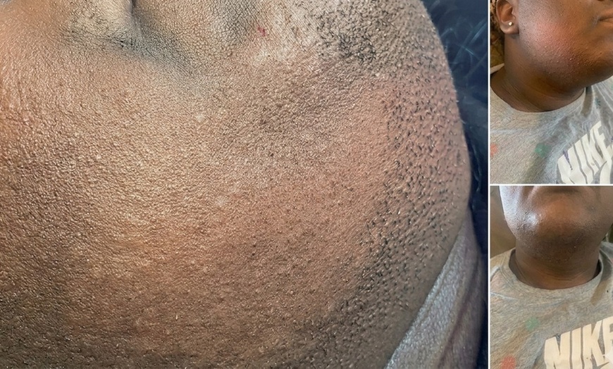 Image 4: Long-Lasting Electrolysis Hair Removal Sessions