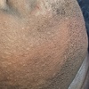 Image 4: Long-Lasting Electrolysis Hair Removal Sessions