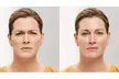 20 Units of Botox at BodyBrite Austin – Quick, Effective Results and Minimal Downtime - Up to 40%% Off - Second Medium