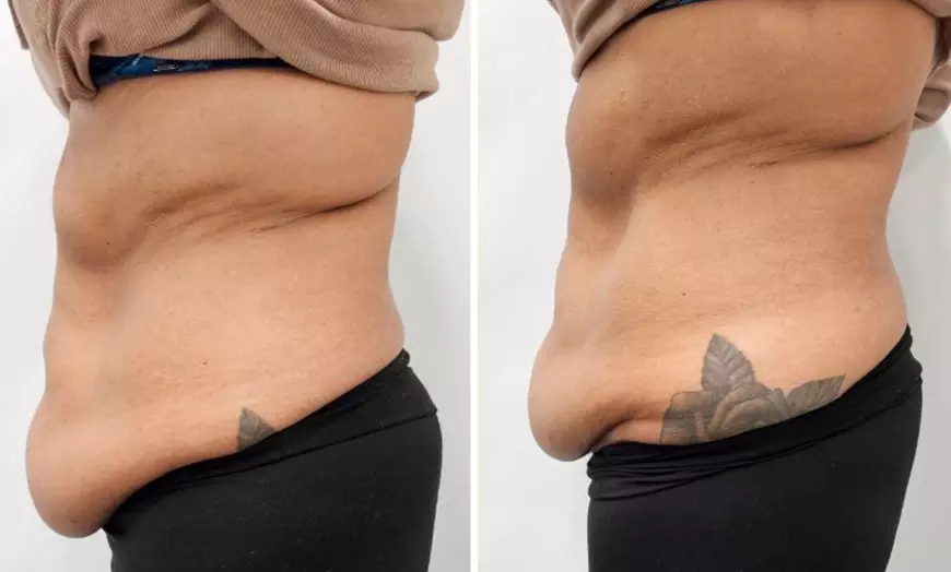 Image 3: Enjoy Pressotherapy Lymphatic Massage, RF Tightening, or Cavitation!