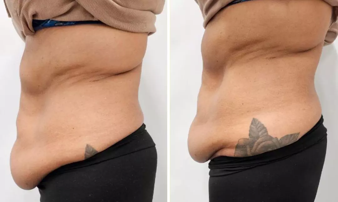 Enjoy Pressotherapy Lymphatic Massage, RF Tightening, or Cavitation!