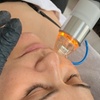 Image 1: 1 oder 2x 60 Min. Radiofrequenz-Microneedling inkl. Seren für 1 Person