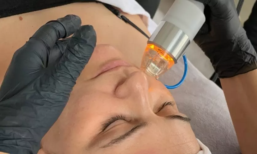 1 oder 2x 60 Min. Radiofrequenz-Microneedling inkl. Seren für 1 Person