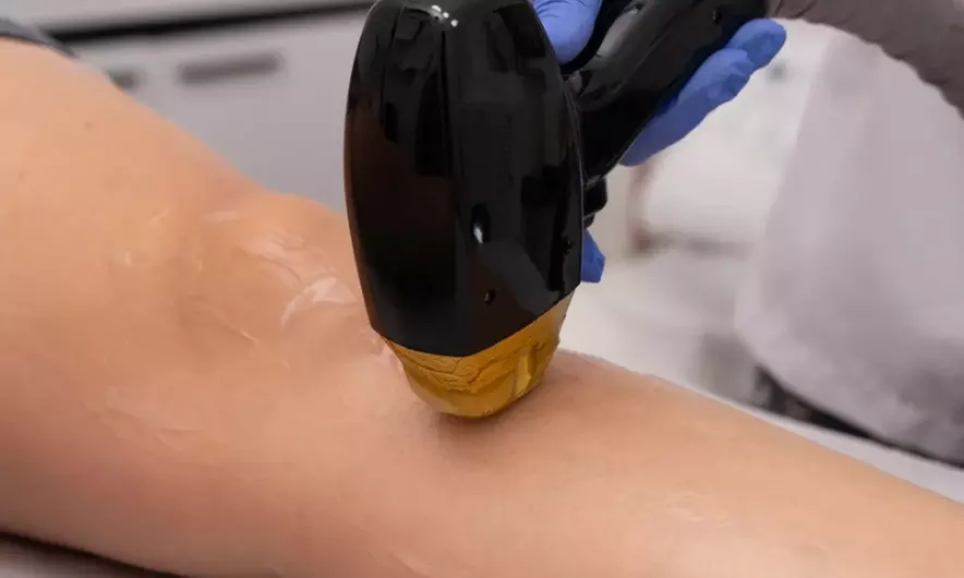 3 or 6 Laser Hair Removal Sessions on a Small, Medium, or Large Area