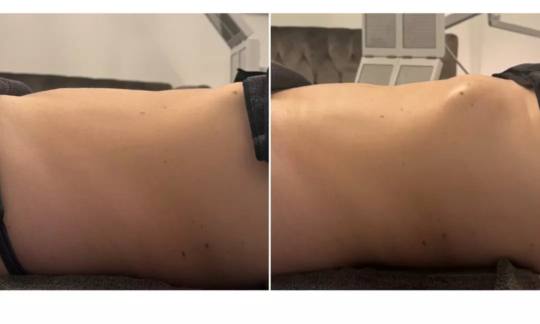 Three, Six, Nine, or Twelve Snella Non-Invasive Laser Lipo Sessions