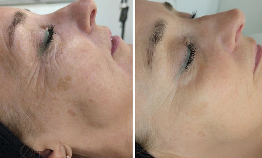 Image 2: Achieve Radiant Skin with One BioRePeel Treatment
