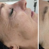Image 2: Achieve Radiant Skin with One BioRePeel Treatment