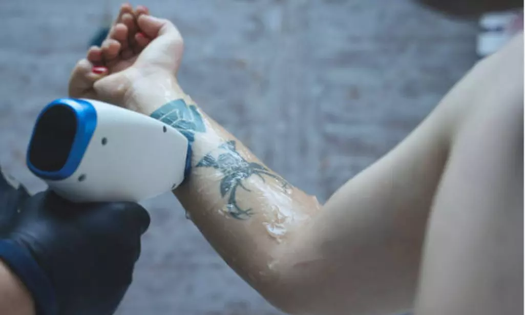 5 o 10 sesiones de eliminación de tatuajes